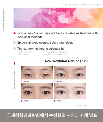 국제성형외과학회에서 눈성형술 시연과 사례 발표