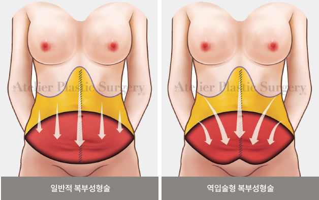 일반적 복부성형술 / 역입술형 복부성형술