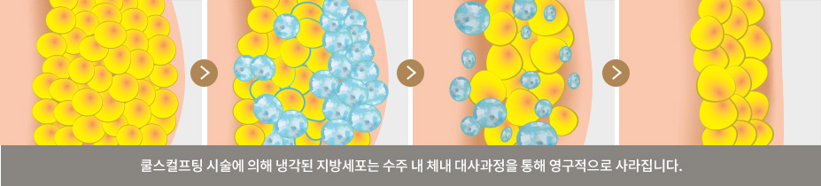 쿨스컬프팅 시술에 의해 냉각된 지방세포는 수주 내 체내 대사과정을 통해 영구적으로 사라집니다.