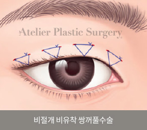 비절개 비유착 쌍꺼풀수술