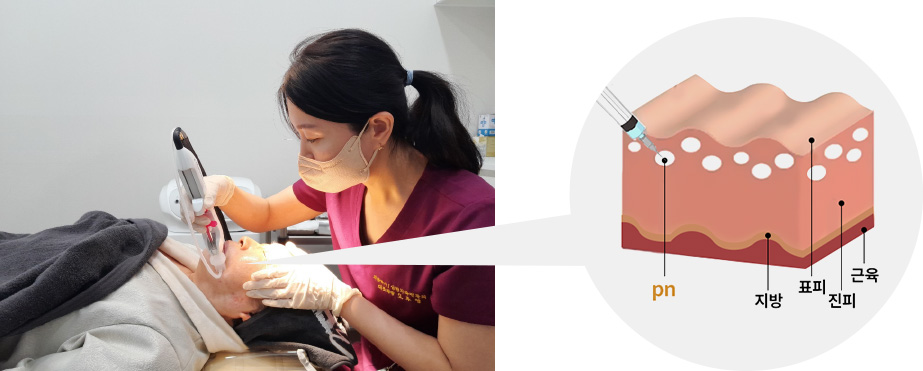 엘레멘트 시술 사진