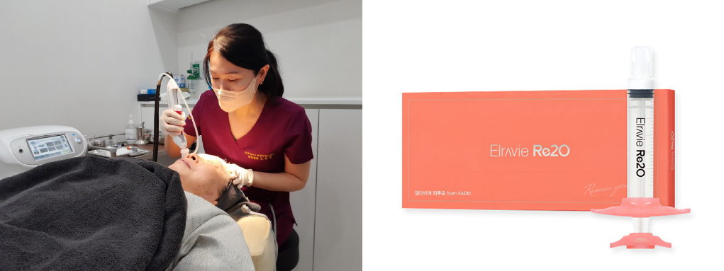 리투오 시술 이미지