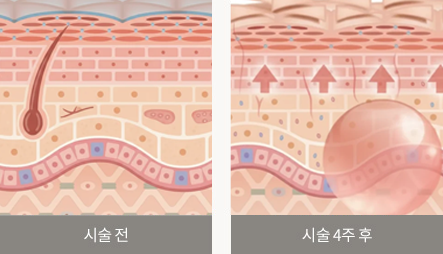 시술 전 / 시술 8주 후