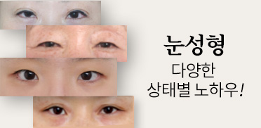 눈성형 다양한 상태별 노하우!