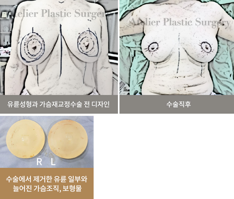 유륜성형과 가슴재교정수술 전 디자인 / 수술 직후 / 수술에서 제거한 유륜 일부와 늘어진 가슴조직, 보형물