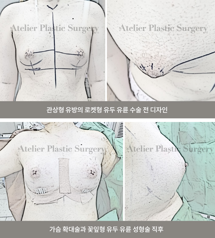 관상형 유방의 로켓형 유두 유륜 수술 전 디자인 / 가슴 확대술과 꽃잎형 유두 유륜 성형술 직후
