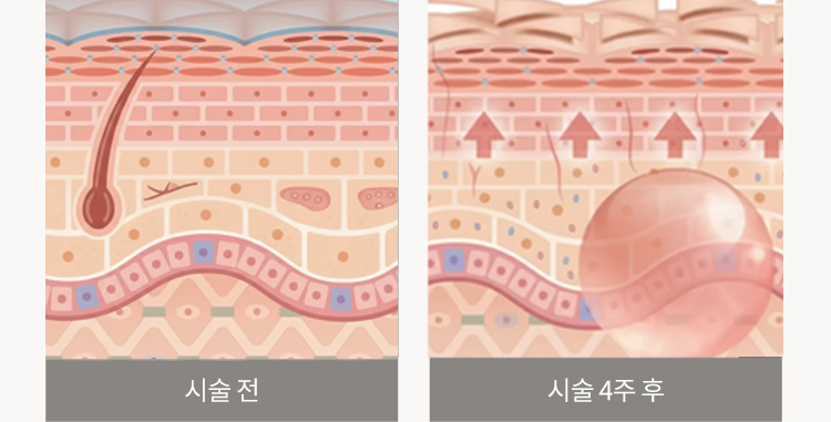 시술 전 / 시술 8주 후